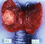thyroid-cancer-papillary
